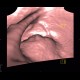 Rectal tumour, virtual colonography: CT - Computed tomography